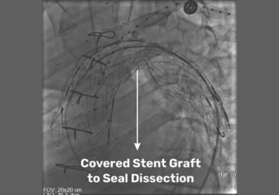 Medical Marvel at SSB Heart and Multispeciality Hospital: Pioneering Hybrid Procedure Saves a Life
